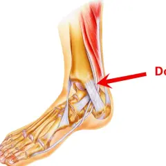 Illustration anatomique du pied montrant la zone de douleur d'une tendinite.