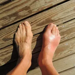 Pied droit enflé et rouge, suggérant une douleur au nerf sur le dessus du pied en marchant. Le pied gauche semble normal.