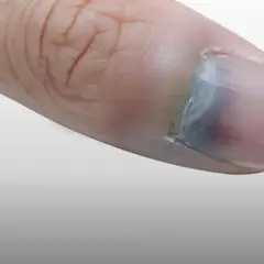 Gros plan d'un pouce avec une ampoule sous l'ongle, causant une décoloration bleuâtre.