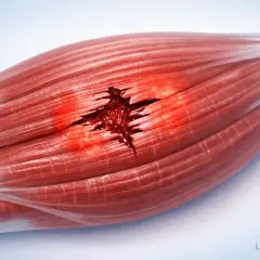 Déchirure profonde dans un muscle, montrant le sang et les fibres musculaires séparées. Un exemple visuel de claquage musculaire.