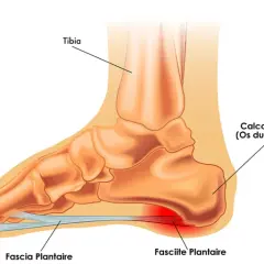 Anatomie du pied montrant la fasciite plantaire, cause fréquente de douleur au talon lors de la course.
