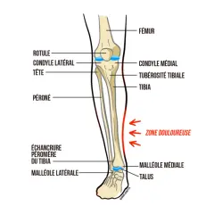Anatomie du tibia, montrant la zone douloureuse sur le côté de l'os.
