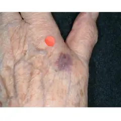 Main de personne âgée avec ecchymose violacée, possible purpura d'effort, marquée par un point rouge.