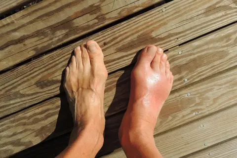 Pied droit enflé et rouge, suggérant une douleur au nerf sur le dessus du pied en marchant. Le pied gauche semble normal.