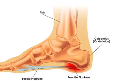 Anatomie du pied montrant la fasciite plantaire, cause fréquente de douleur au talon lors de la course.