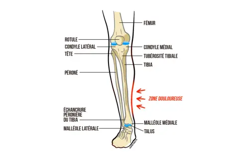 Anatomie du tibia, montrant la zone douloureuse sur le côté de l'os.