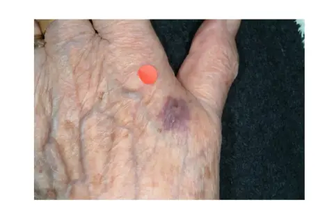 Main de personne âgée avec ecchymose violacée, possible purpura d'effort, marquée par un point rouge.