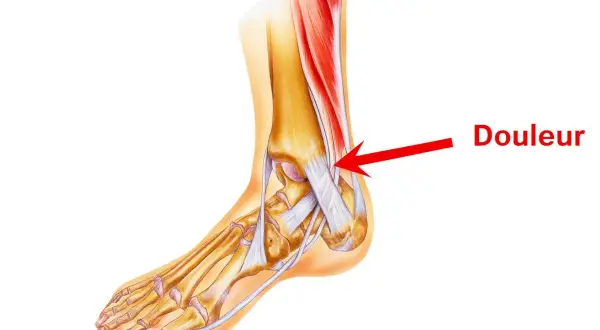 Illustration anatomique du pied montrant la zone de douleur d'une tendinite.