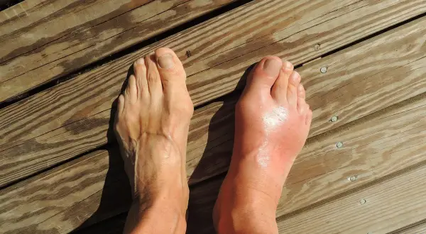 Pied droit enflé et rouge, suggérant une douleur au nerf sur le dessus du pied en marchant. Le pied gauche semble normal.