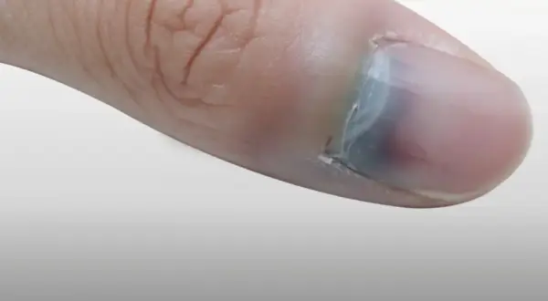 Gros plan d'un pouce avec une ampoule sous l'ongle, causant une décoloration bleuâtre.