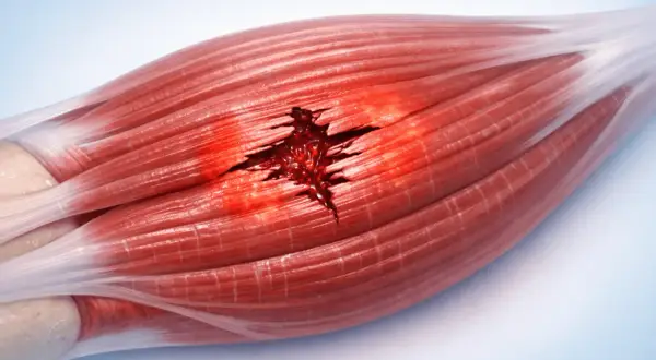 Déchirure profonde dans un muscle, montrant le sang et les fibres musculaires séparées. Un exemple visuel de claquage musculaire.