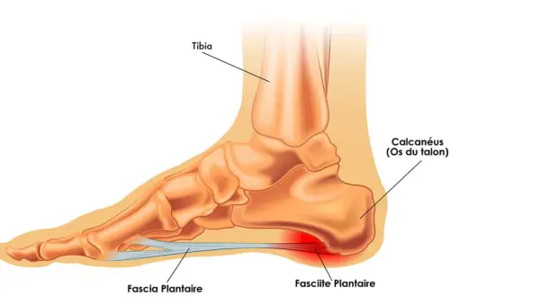 Anatomie du pied montrant la fasciite plantaire, cause fréquente de douleur au talon lors de la course.