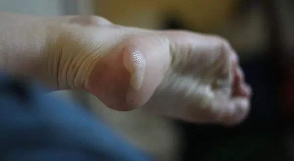 Gros plan sur un pied avec une ampoule visible sur le talon. La peau est plissée, signe d'une longue marche.