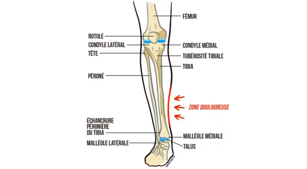 Anatomie du tibia, montrant la zone douloureuse sur le côté de l'os.