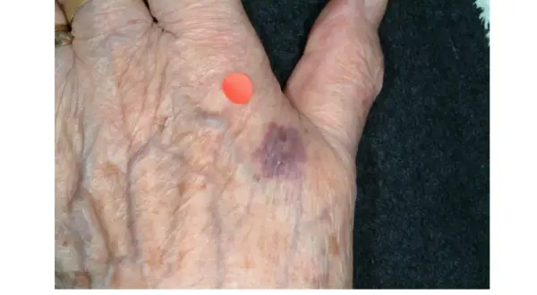 Main de personne âgée avec ecchymose violacée, possible purpura d'effort, marquée par un point rouge.