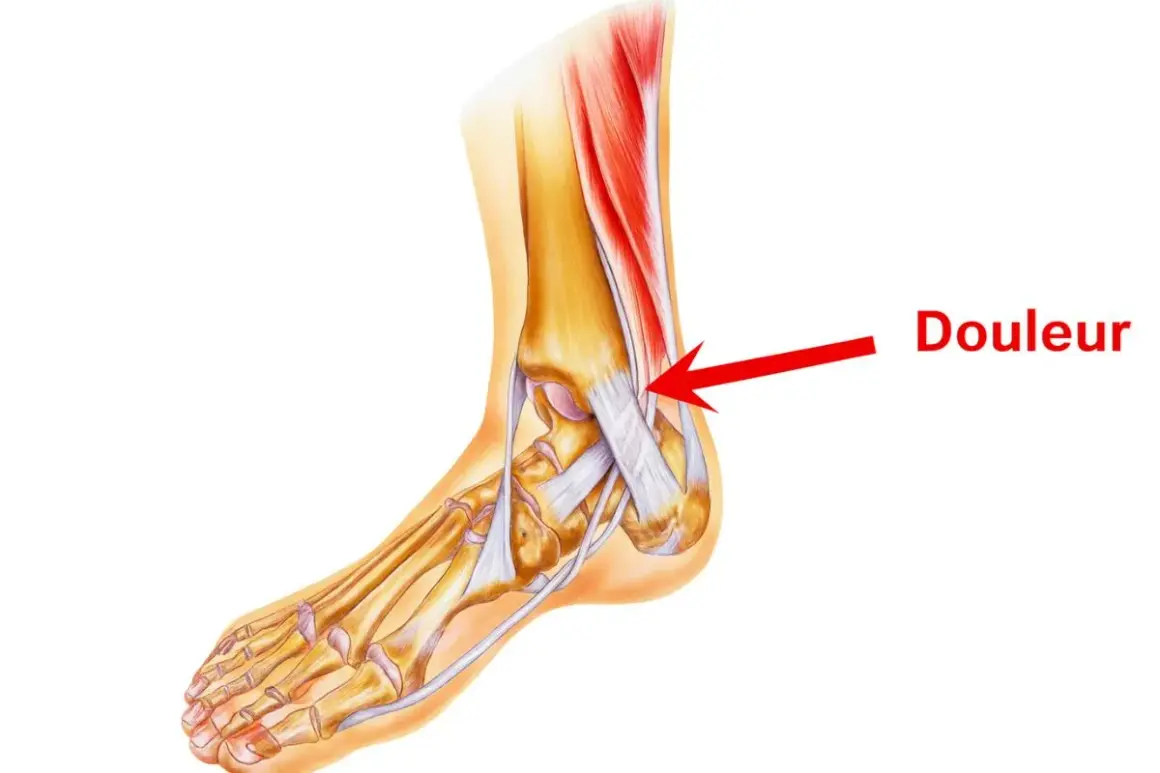 Illustration anatomique du pied montrant la zone de douleur d'une tendinite.