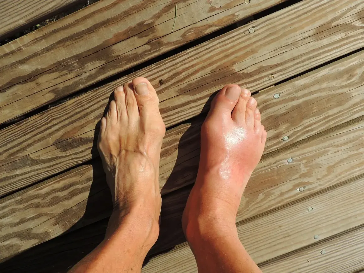 Pied droit enflé et rouge, suggérant une douleur au nerf sur le dessus du pied en marchant. Le pied gauche semble normal.