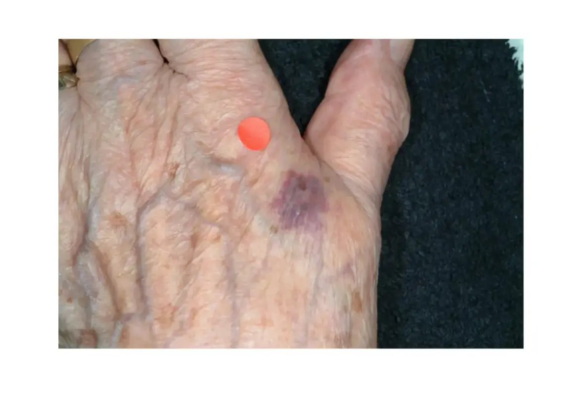 Main de personne âgée avec ecchymose violacée, possible purpura d'effort, marquée par un point rouge.