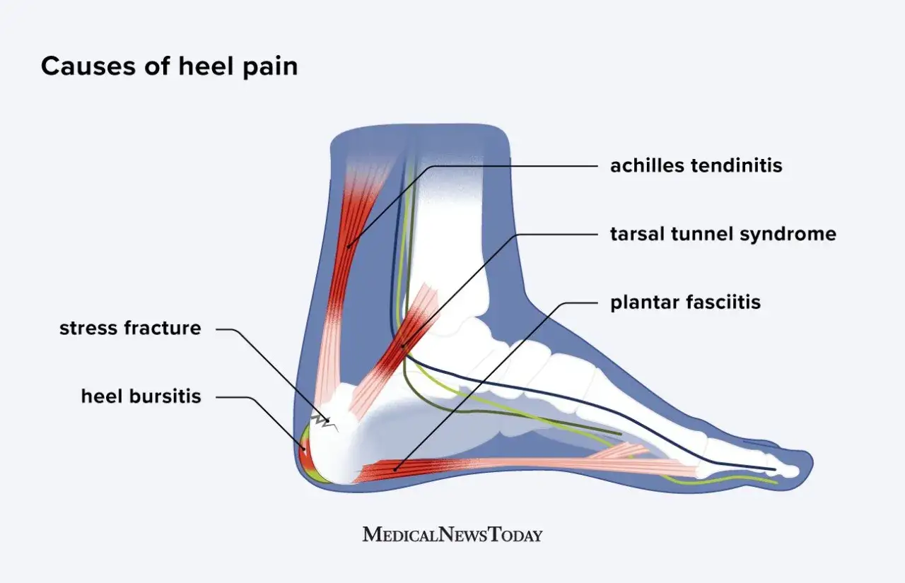 Anatomie du pied montrant les causes de la douleur au talon, comme la fasciite plantaire, souvent ressentie lors de la course à pied.