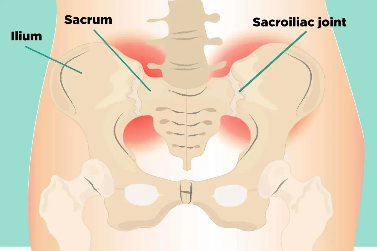 Illustration anatomique du bassin montrant la douleur au sacrum et &agrave; l'articulation sacro-iliaque.