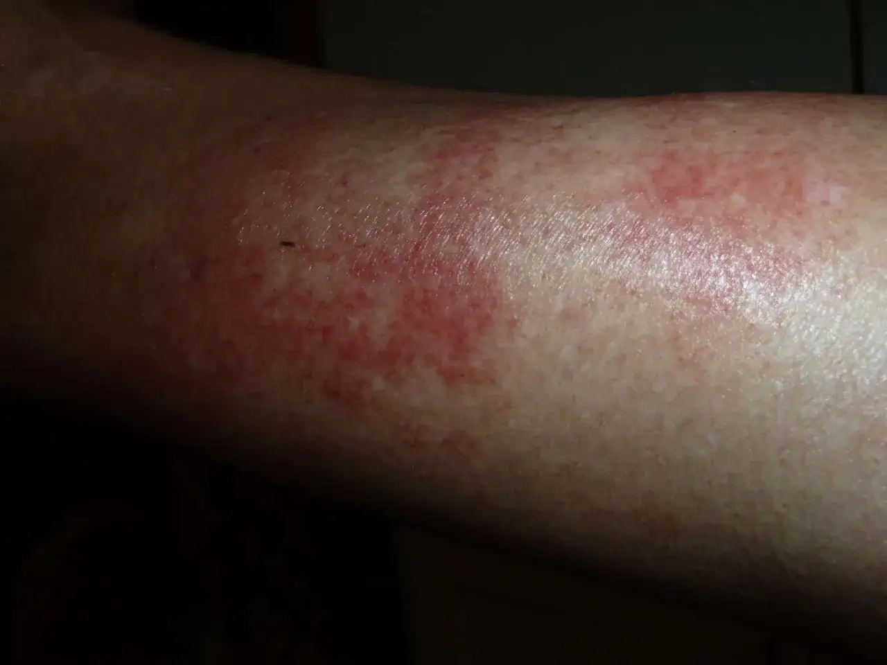 &Eacute;ruption cutan&eacute;e rouge sur un bras, possiblement un purpura d'effort apr&egrave;s une activit&eacute; physique intense.