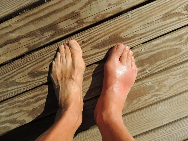 Pied droit enflé et rouge, suggérant une douleur au nerf sur le dessus du pied en marchant. Le pied gauche semble normal.