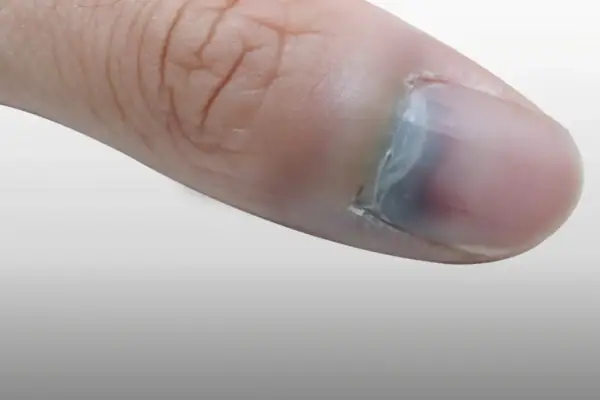 Gros plan d'un pouce avec une ampoule sous l'ongle, causant une décoloration bleuâtre.