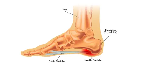 Anatomie du pied montrant la fasciite plantaire, cause fréquente de douleur au talon lors de la course.